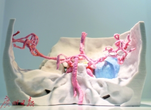 邁普再生醫學展示的3D打印顱頸交界腫瘤模型。